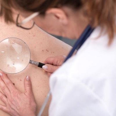 A person in a white coat and goggles is using a magnifying glass to examine spots on a person's back.